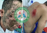Bệnh viện đa khoa tỉnh Kon Tum: Hồi phục diệu kì của người bệnh mắc Pemphigus hiếm gặp